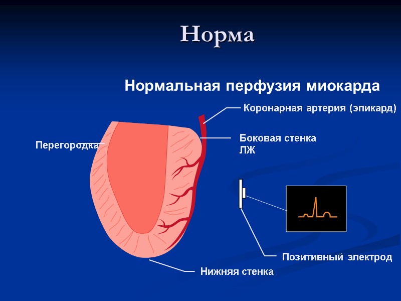 Норма Коронарная артерия (эпикард) Боковая стенка ЛЖ Позитивный электрод Перегородка Нижняя стенка Нормальная перфузия